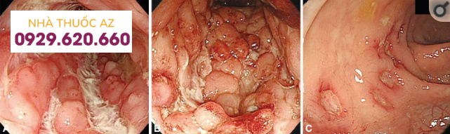 Đặc điểm nội soi điển hình của bệnh Crohn.