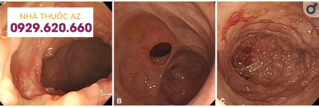 Các đặc điểm nội soi điển hình của lao ruột