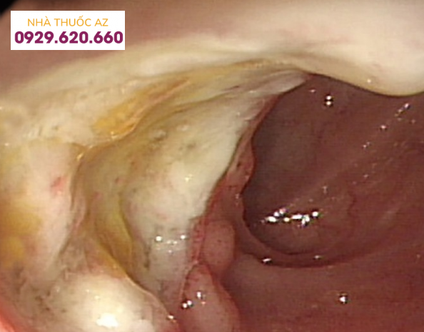 Đặc điểm nội soi điển hình của bệnh Behcet đường ruột