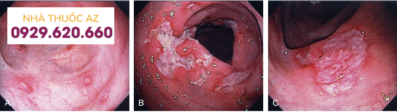 Hình ảnh loét đại tràng đa ổ do bệnh Crohn