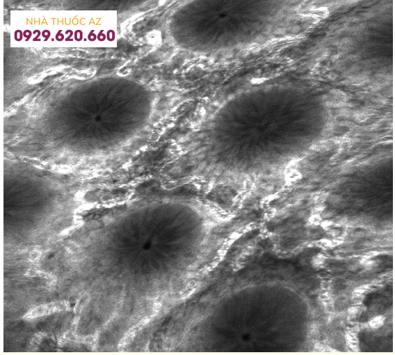 Nội soi bằng laser đồng tiêu