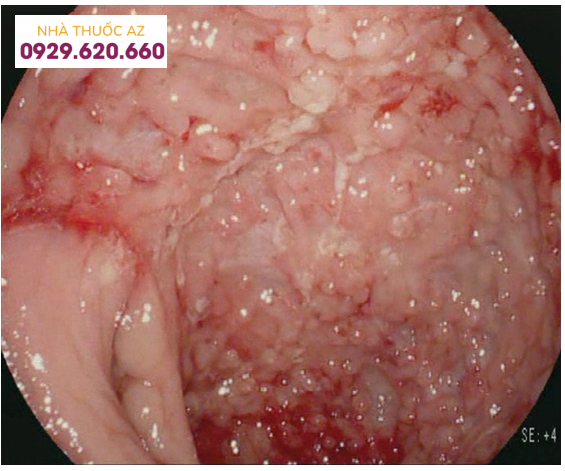 Nội soi ánh sáng trắng độ nét cao của bệnh Crohn nặng với nhiều vết loét dọc và xuất huyết tự phát của niêm mạc bị viêm.