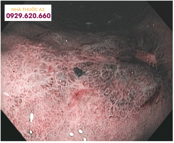 Vết loét lớn được kiểm tra bằng hình ảnh dải hẹp. NBI hình dung kiến trúc bề mặt không đều và cấu trúc mạch máu bị xáo trộn. Mô bệnh học khẳng định chẩn đoán ung thư.