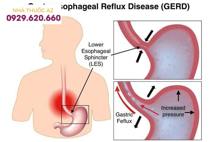 Cơ thắt thực quản dưới (Lower esophageal Sphincter –LES) đóng vai trò quan trọng trong chứng ợ nóng