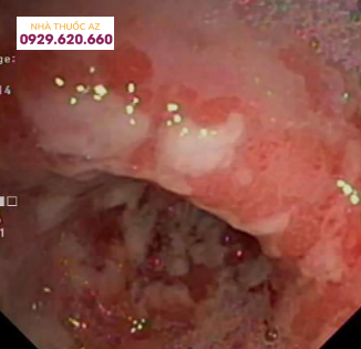 Tổn thương ở hang vị dạ dày do bệnh Crohn