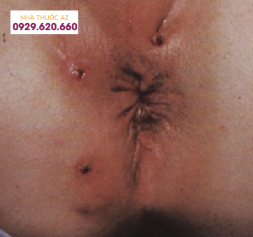 Tổn thương nhiều lỗ rò ở hậu môn do bệnh Crohn