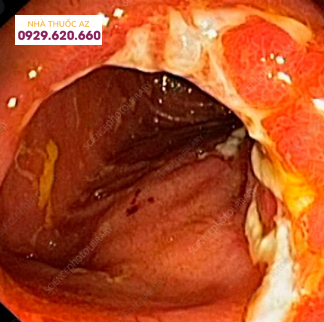 Hình ảnh bệnh Crohn ở hồi tràng được nhìn thấy qua nội soi với nhiều ổ loét