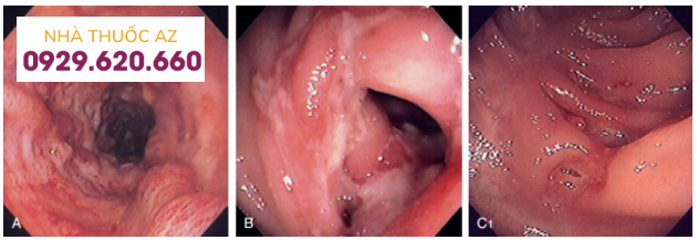 Tổn thương của bệnh Crohn ở đại tràng được nhìn thấy qua nội soi đại tràng