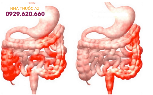 Đặc điểm tổn thương của bệnh Crohn là tổn thương từng đoạn không liên tục trên ống tiêu hoá