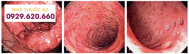 Hình ảnh nội soi của bệnh Crohn