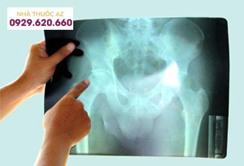 Thay khớp háng - giải pháp tối ưu cho người bị tiêu chỏm xương đùi nặng