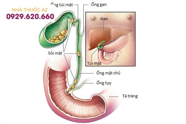 Sỏi ống mật chủ