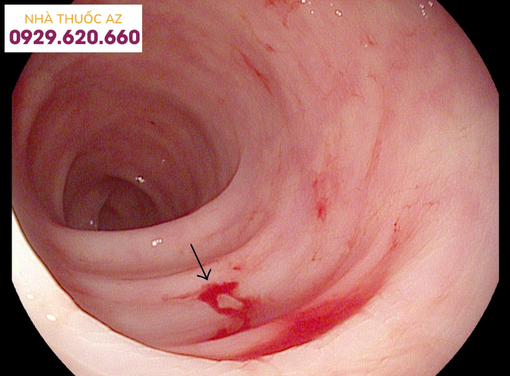Nội soi đại tràng diễn ra như thế nào?
