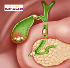 Cách điều trị sỏi ống mật chủ