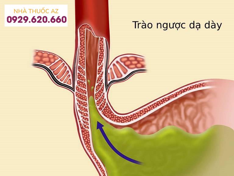 Trào ngược dạ dày