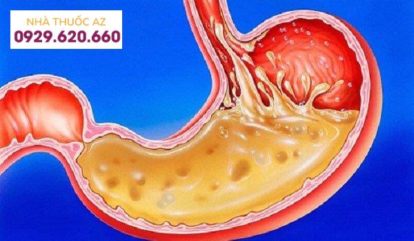 Nồng độ axit quá cao gây viêm loét dạ dày
