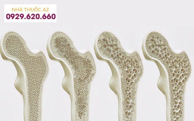 loãng xương