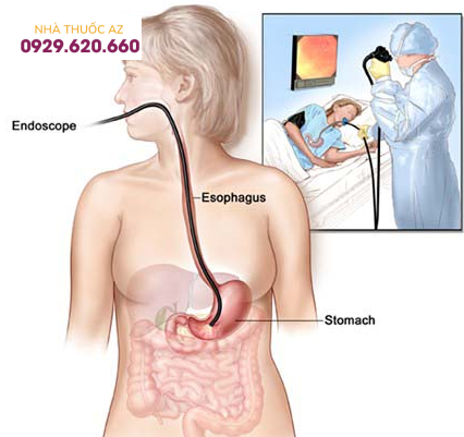 Nội soi dạ dày thực quản