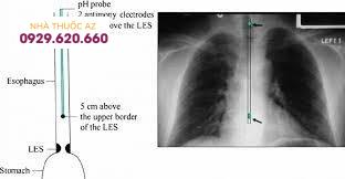 Nguyên lý của đo pH thực quản 24 giờ