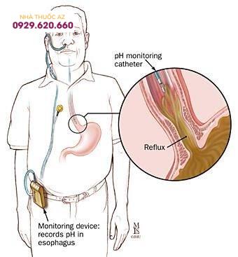 Kỹ thuật đo pH thực quản 24 giờ