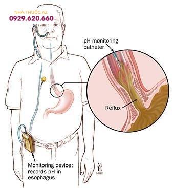 Kỹ thuật đo pH thực quản 24 giờ