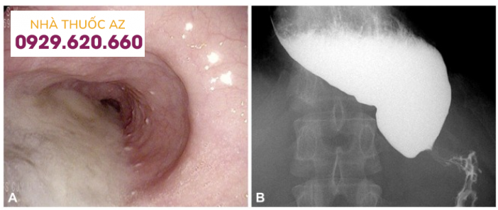 Hình ảnh nội soi và X quang thực quản cản quang của bệnh co thắt tâm vị achalasia