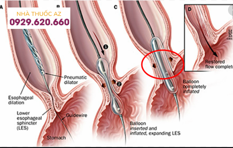 Nong bằng bóng qua nội soi điều trị co thắt tâm vị