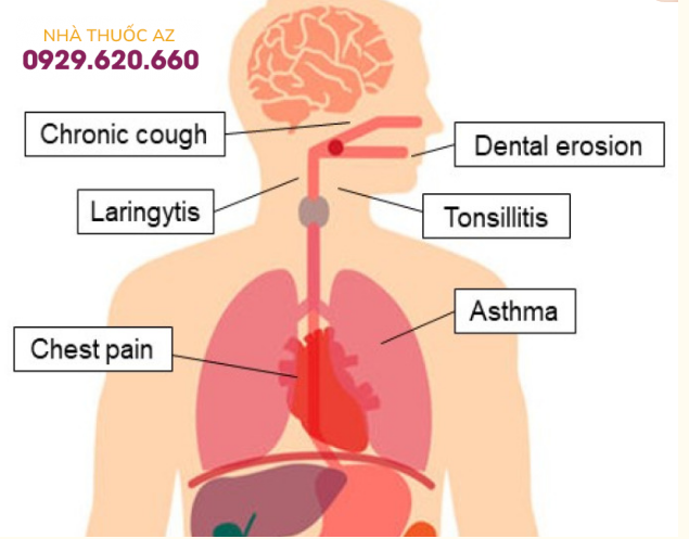 Các biểu hiện ngoài thực quản của bệnh trào ngược dạ dày thực quản.