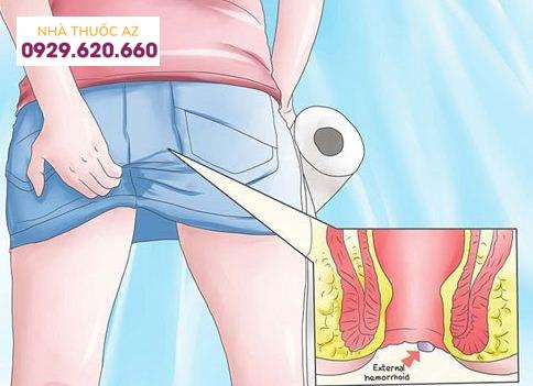 Đau rát vùng hậu môn có phải bệnh trĩ không?