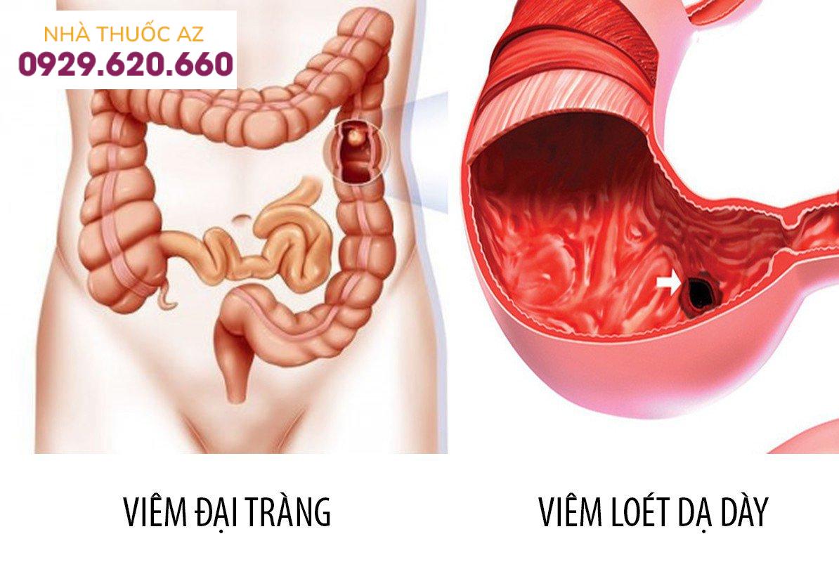 Viêm loét đại tràng