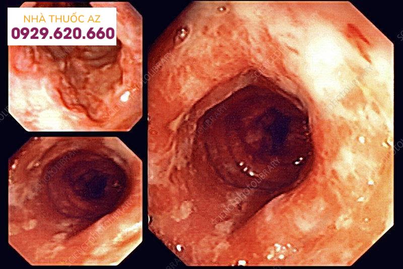 Hình ảnh viêm ruột non