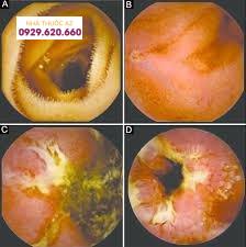 Hình ảnh viêm ruột non qua nội soi viên nang