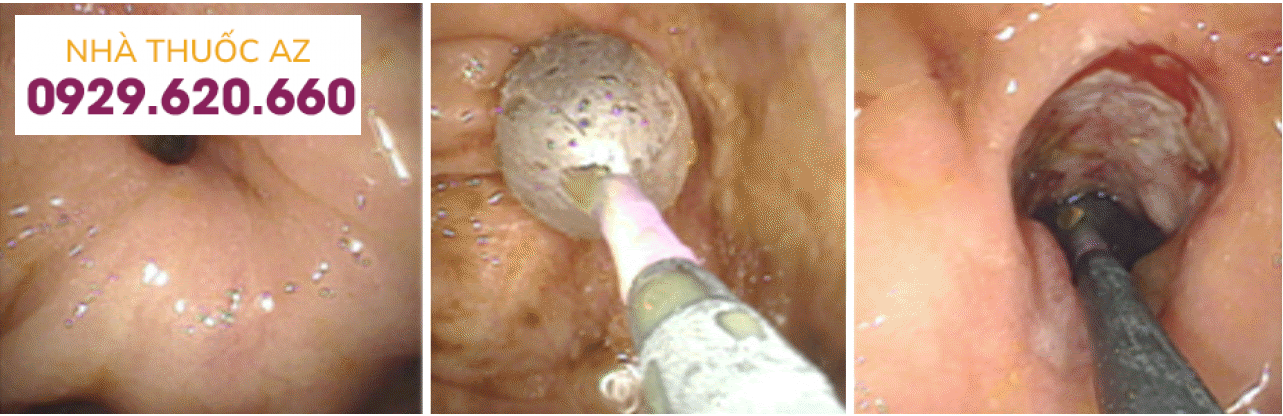 Kỹ thuật nong bằng bóng qua nội soi