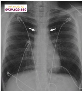 Hình ảnh X quang thể hiện tràn khí trung thất do hội chứng Boerhaave