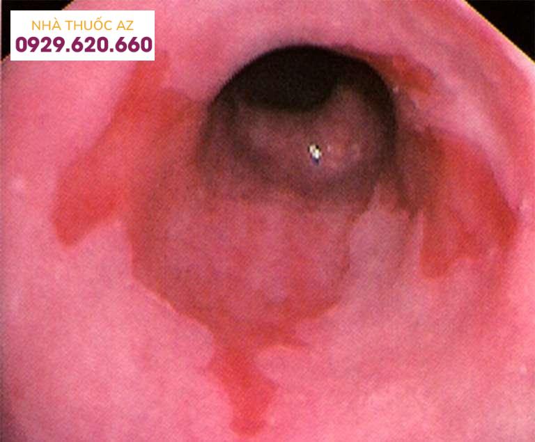 Ảnh hưởng nhiễm H. pylori lên quá trình tạo ung thư của thực quản Barrett