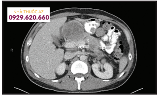 Chụp CT Scan bụng cho thấy phúc mạc của ổ bụng bị xâm lấn dọc theo vách sau dạ dày và một nốt 1,5 cm trên mặt sau của hang vị dạ dày.