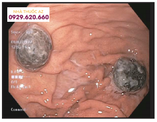 Hình ảnh nội soi dạ dày: tổn thương thâm nhiễm kích thước khoảng 1,5cm rải rác ở thân dạ dày.