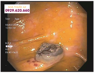 Nội soi đại tràng cho thấy một khối 1 cm thâm nhiễm, không gây tắc ở đại tràng ngang