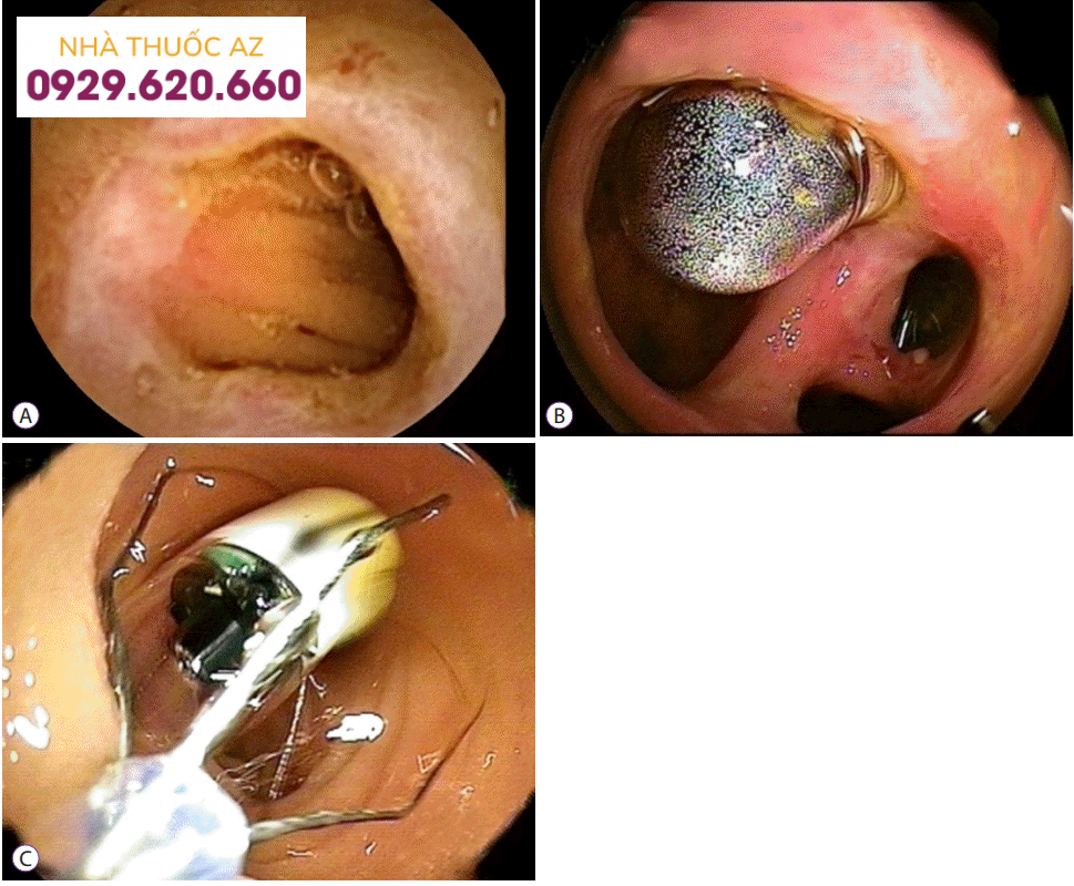 Hình ảnh viên nang nội soi bị hẹp do viêm, phải tiến hành nội soi ruột non để lấy viên nang ra