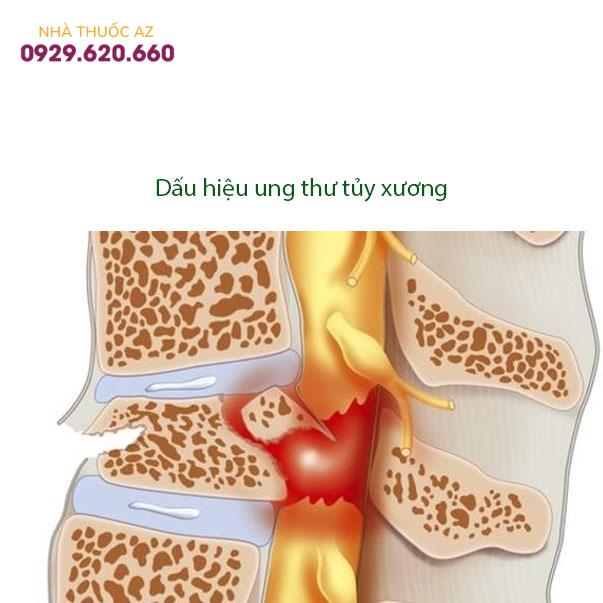 Dấu-hiệu-ung-thư-tủy-xương