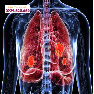 Dấu hiệu của ung thư phổi giai đoạn đầu