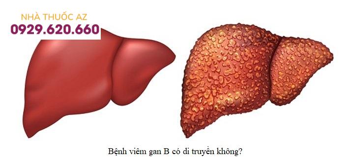 Bệnh viêm gan B có di truyền không