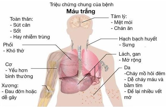 dấu hiệu ung thư máu giai đoạn cuối