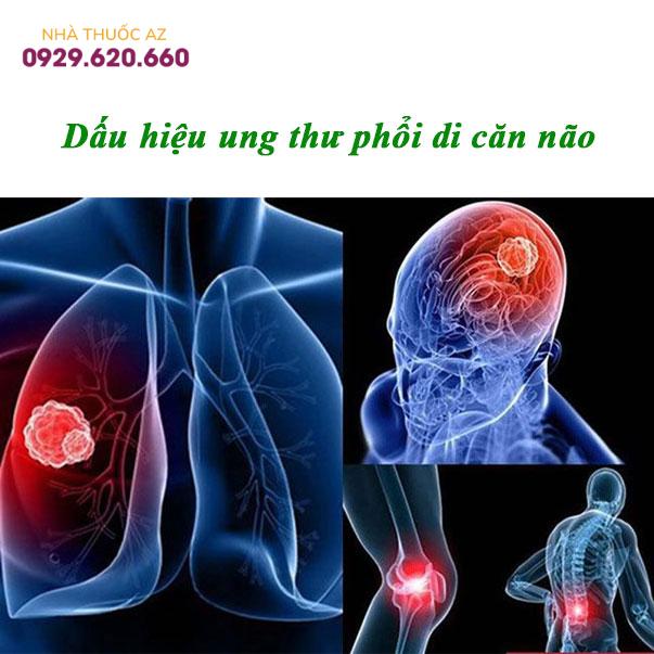 Dấu-hiệu-ung-thư-phổi-di-căn-não