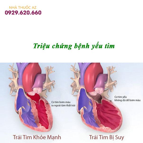 Triệu-chứng-bệnh-yếu-tim