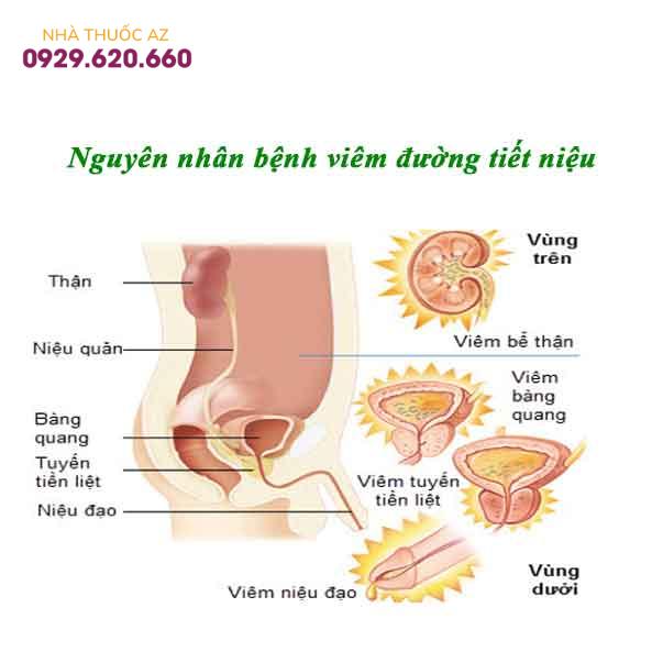 Nguyên-nhân-bệnh-viêm-đường-tiết-niệu