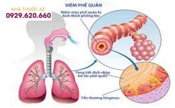 Bệnh viêm đường hô hấp cấp tính do vi rút