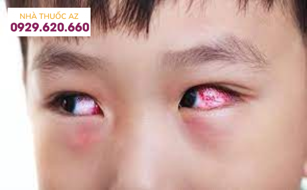Triệu chứng đau mắt đỏ ở trẻ em