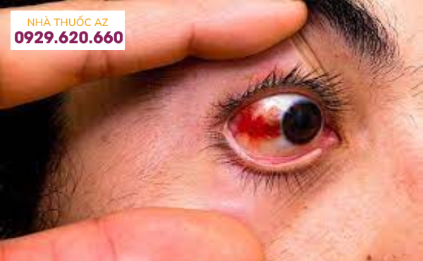 Bệnh đau mắt đỏ có nguy hiểm không