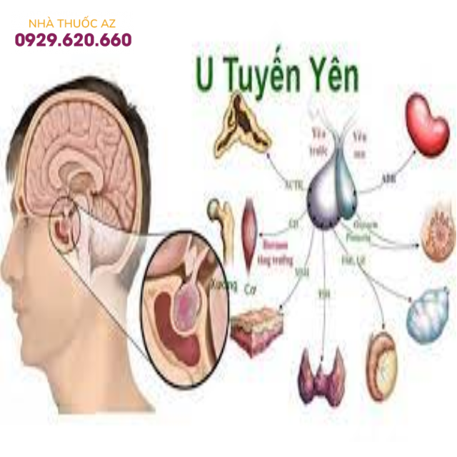 Dấu hiệu ung thư tuyến yên